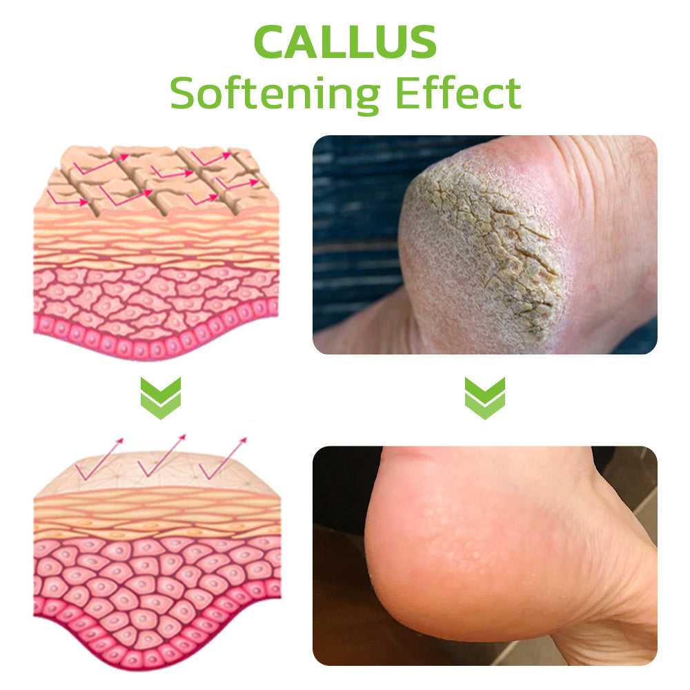 IHerbal Foot Callus And Corns Removal Soak