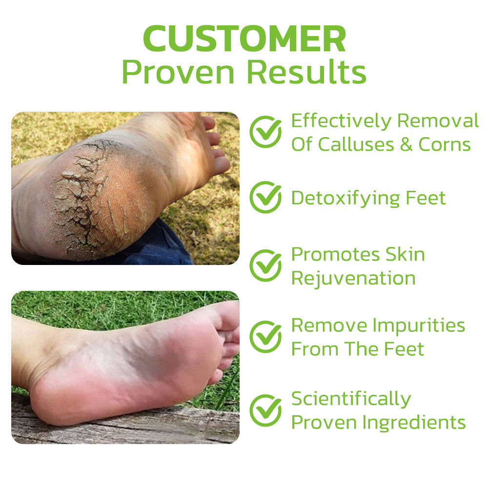 IHerbal Foot Callus And Corns Removal Soak